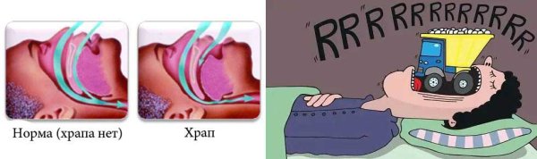Операция чтобы не храпеть