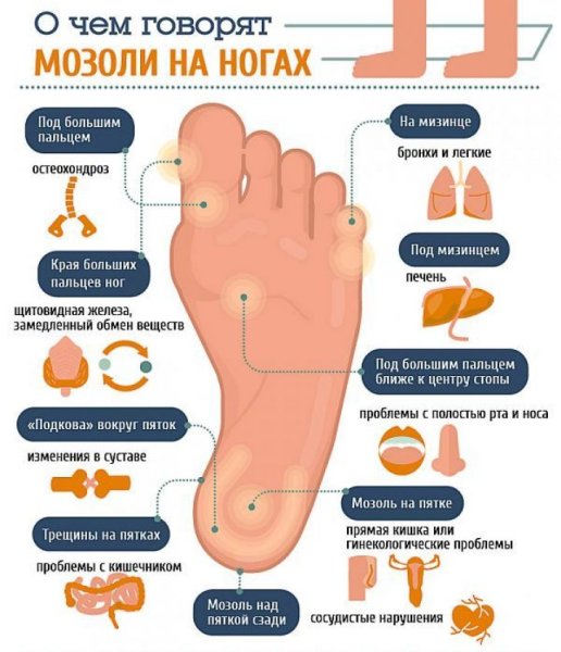 Стержневая мозоль на стопе