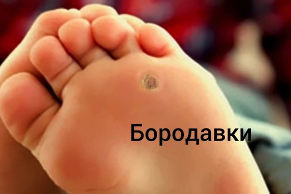 Ладонно-подошвенные бородавки