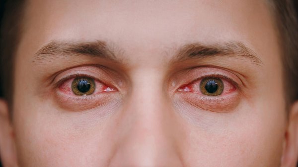 Retouch4me Eye Vessels 1.010